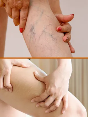 The Difference Between Varicose Veins And Stretch Marks